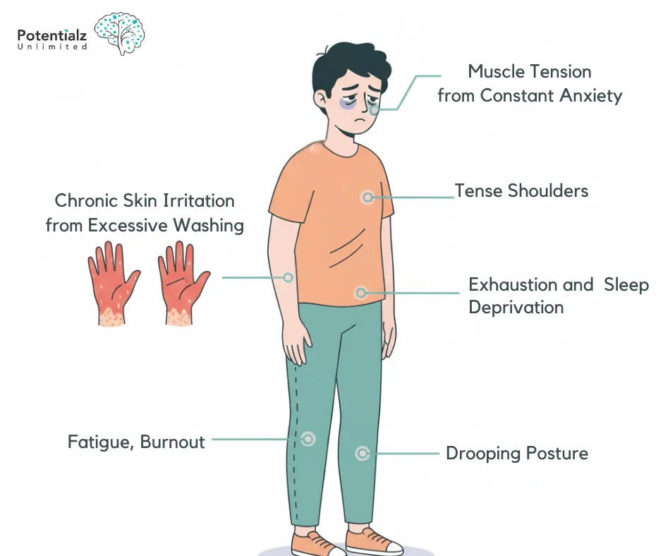Illustration depicting the physical impact of contamination OCD, highlighting chronic skin irritation, muscle tension, and signs of fatigue and exhaustion.